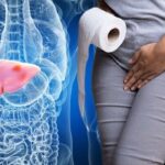 Stages of Liver Disease Is Dark Urine