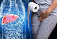 Stages of Liver Disease Is Dark Urine